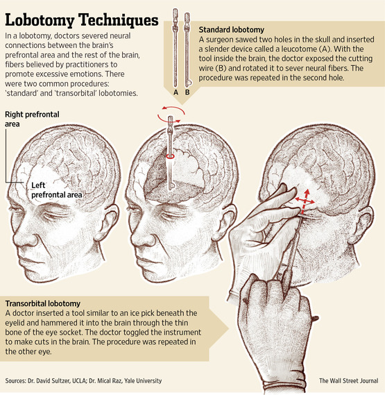 Лоботомия сейчас делают. Префронтальная Лоботомия для чего. Лаботтмив. Трансорбитальная Лоботомия.